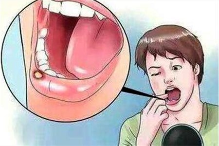 口腔溃疡要怎么治好的最快